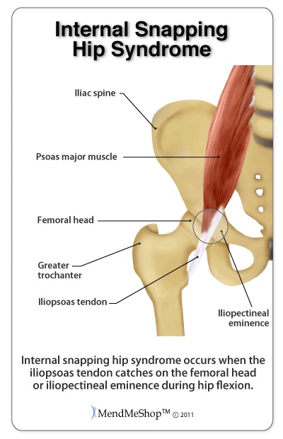 What is Snapping Hip Syndrome?