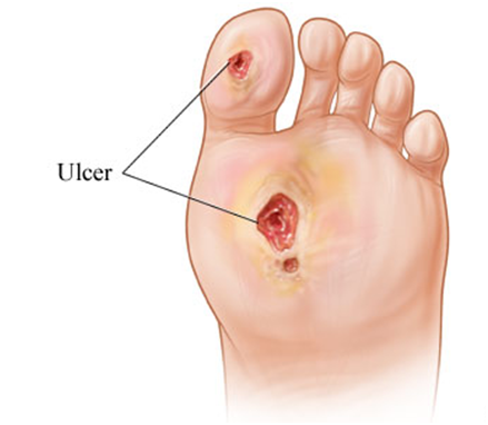 Image CRedit: http://www.gotfootsores.com/about-diabetic-foot-ulcers/