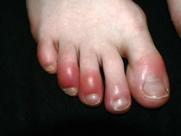 chilblains in toes
