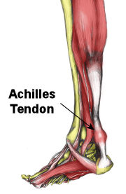 physio to treat achilles heal problems