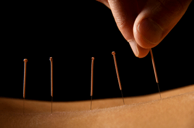 acupunture dry needling by physiotherapists