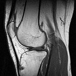 MRI of knee