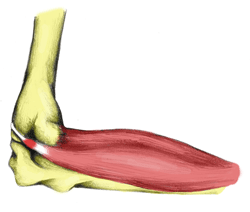 tennis elbow treated by physiotherapists