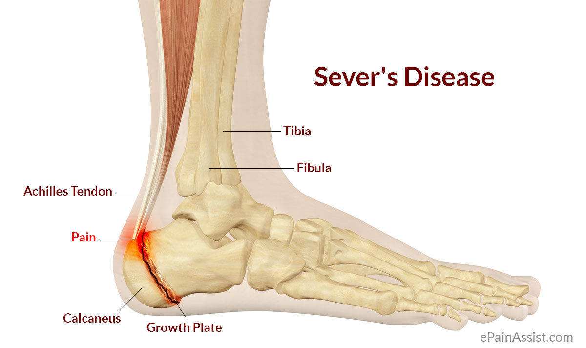 Fix heel pain severs disease | Physio, Podiatry & Massage